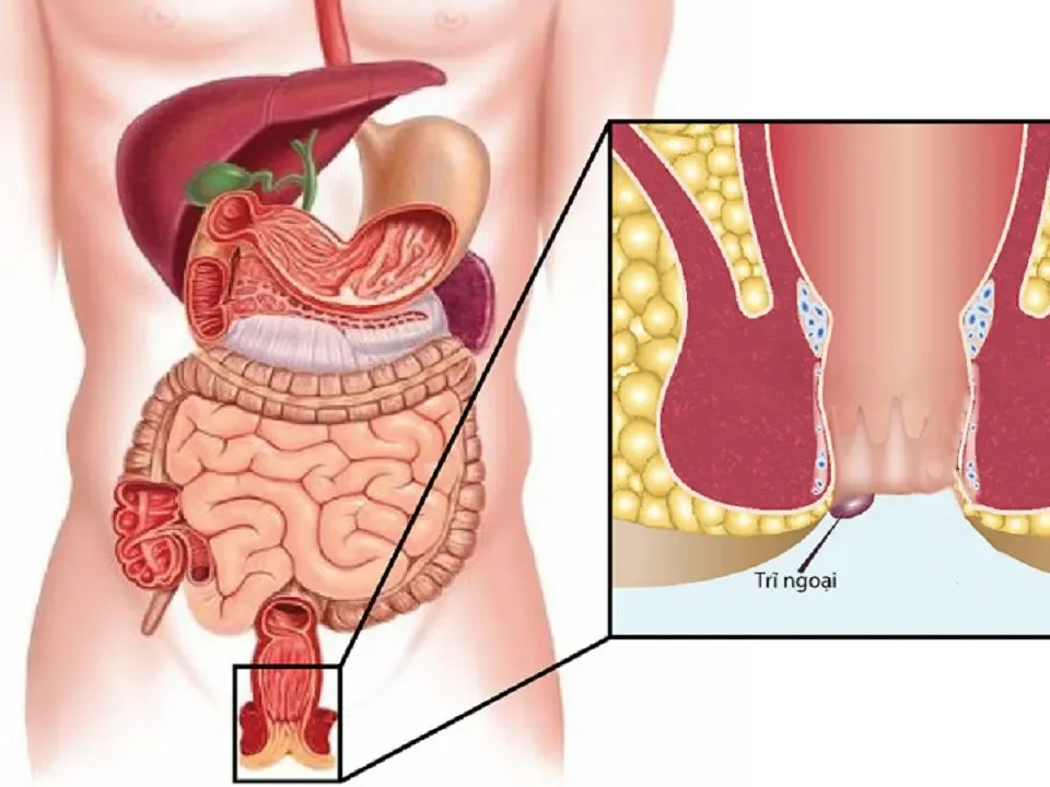 Hình ảnh trĩ ngoại nhẹ
