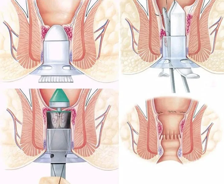 Phương pháp phẫu thuật khâu treo triệt mạch trĩ (PPH – Longo)