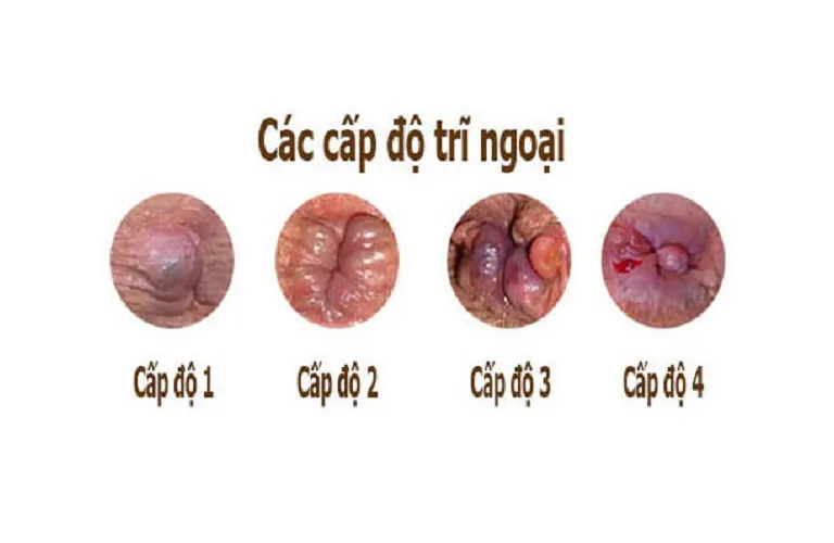 Trĩ ngoại nhẹ là gì